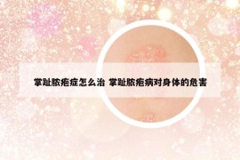 掌趾脓疱症怎么治 掌趾脓疱病对身体的危害