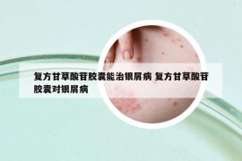 复方甘草酸苷胶囊能治银屑病 复方甘草酸苷胶囊对银屑病