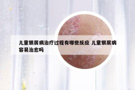 儿童银屑病治疗过程有哪些反应 儿童银屑病容易治愈吗