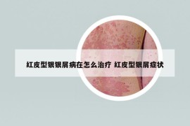 红皮型银银屑病在怎么治疗 红皮型银屑症状