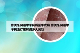 修美乐阿达木单抗质量牛皮癣 修美乐阿达木单抗治疗银屑病多久见效