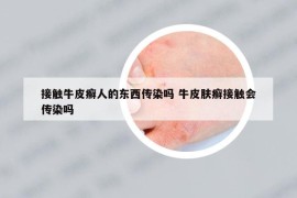 接触牛皮癣人的东西传染吗 牛皮肤癣接触会传染吗