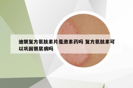 迪银复方氨肽素片是激素药吗 复方氨肽素可以巩固银屑病吗