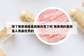 得了银屑病是基因被改变了吗 银屑病的基因是人类最优秀的