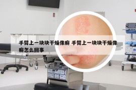 手臂上一块块干燥像癣 手臂上一块块干燥像癣怎么回事