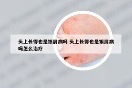 头上长得也是银屑病吗 头上长得也是银屑病吗怎么治疗