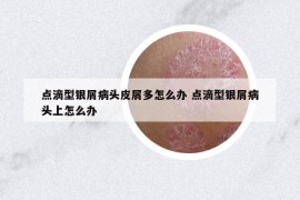 点滴型银屑病头皮屑多怎么办 点滴型银屑病头上怎么办