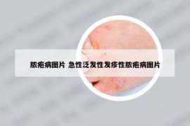 脓疱病图片 急性泛发性发疹性脓疱病图片