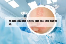 银屑病可以喝黄芪水吗 银屑病可以喝黄芪水吗