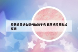 后天银屑病会遗传给孩子吗 银屑病后天形成原因