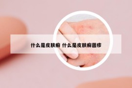 什么是皮肤癣 什么是皮肤癣菌疹