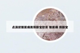 点滴状银屑病用得肤宝软膏 银屑病 得肤宝