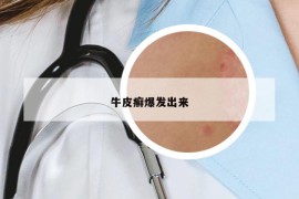 牛皮癣爆发出来