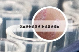 怎么治副银屑病 副银屑病根治