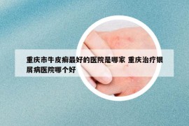 重庆市牛皮癣最好的医院是哪家 重庆治疗银屑病医院哪个好