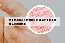 脸上长癣是什么原因引起的 孩子脸上长癣是什么原因引起的