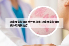 轻度寻常型银屑病外用药物 轻度寻常型银屑病外用药物治疗