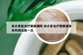 白介素能治疗银屑病吗 白介素治疗银屑病多长时间注射一次