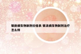 银削病生物制剂价格表 银消病生物制剂治疗怎么样