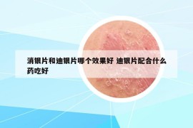 消银片和迪银片哪个效果好 迪银片配合什么药吃好