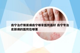 南宁治疗银屑病南宁哪家医院最好 南宁专治皮肤病的医院在哪里