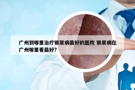 广州到哪里治疗银屑病最好的医院 银屑病在广州哪里看最好?