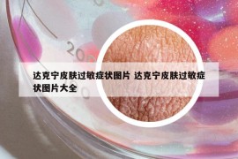 达克宁皮肤过敏症状图片 达克宁皮肤过敏症状图片大全