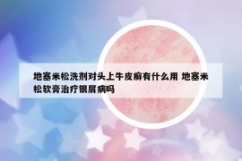 地塞米松洗剂对头上牛皮癣有什么用 地塞米松软膏治疗银屑病吗