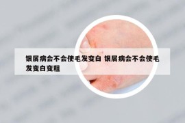 银屑病会不会使毛发变白 银屑病会不会使毛发变白变粗