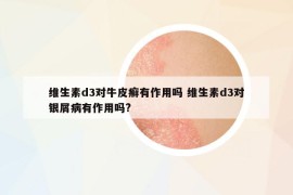 维生素d3对牛皮癣有作用吗 维生素d3对银屑病有作用吗?