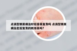 点滴型银屑病治好后容易复发吗 点滴型银屑病治愈后复发的概率高吗?