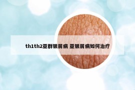 th1th2亚群银屑病 亚银屑病如何治疗