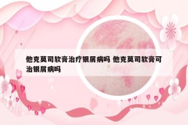 他克莫司软膏治疗银屑病吗 他克莫司软膏可治银屑病吗