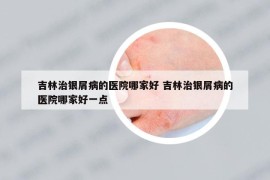 吉林治银屑病的医院哪家好 吉林治银屑病的医院哪家好一点