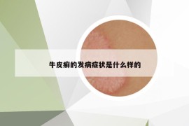 牛皮癣的发病症状是什么样的