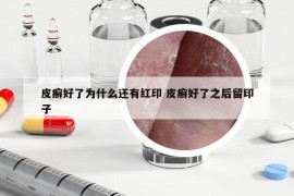 皮癣好了为什么还有红印 皮癣好了之后留印子