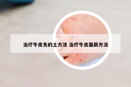 治疗牛皮先的土方法 治疗牛皮最新方法