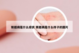 银翘病是什么症状 银翘病是什么样子的图片