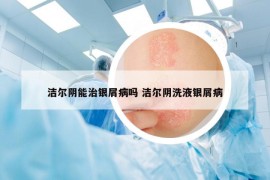 洁尔阴能治银屑病吗 洁尔阴洗液银屑病