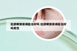 肚脐眼银屑病能治好吗 肚脐眼银屑病能治好吗男性