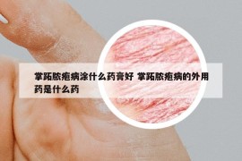 掌跖脓疱病涂什么药膏好 掌跖脓疱病的外用药是什么药