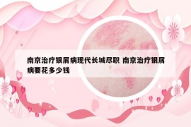 南京治疗银屑病现代长城尽职 南京治疗银屑病要花多少钱