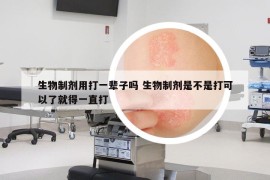 生物制剂用打一辈子吗 生物制剂是不是打可以了就得一直打