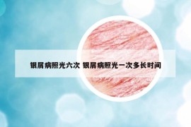 银屑病照光六次 银屑病照光一次多长时间