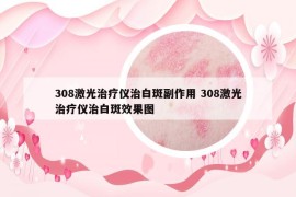 308激光治疗仪治白斑副作用 308激光治疗仪治白斑效果图