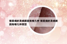 银屑病的发病原因有哪几种 银屑病的发病原因有哪几种类型