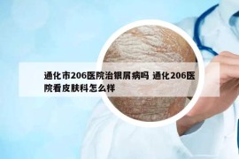 通化市206医院治银屑病吗 通化206医院看皮肤科怎么样