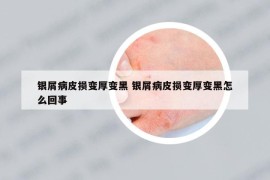 银屑病皮损变厚变黑 银屑病皮损变厚变黑怎么回事