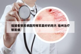 福建看银屑病医院哪家最好的地方 福州治疗银屑病