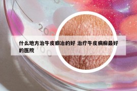 什么地方治牛皮癖冶的好 治疗牛皮病癣最好的医院